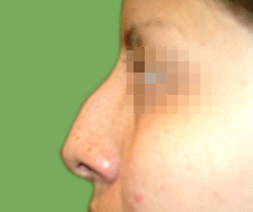 Antes de operación estética nariz