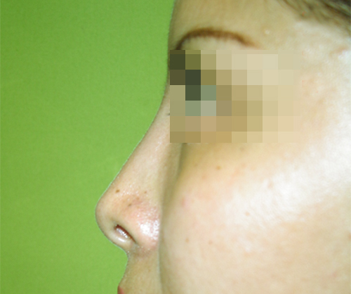 Después operación de cirugía estética nariz