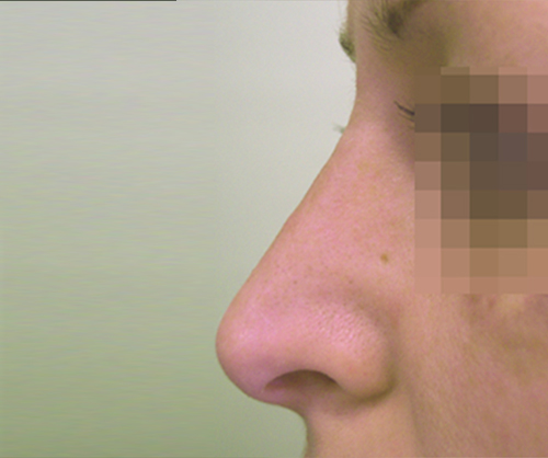 Después operación de nariz, rinoplastia antes y después en mujeres