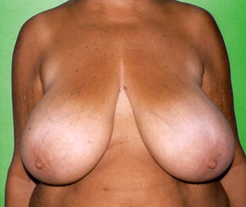 Antes de cirugía estética reducción de pecho, imágenes de reducción de senos