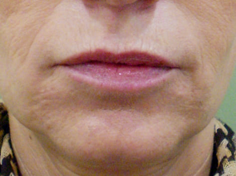 Después cirugía estética de remodelación facial perioral, antes y después de remodelación facial
