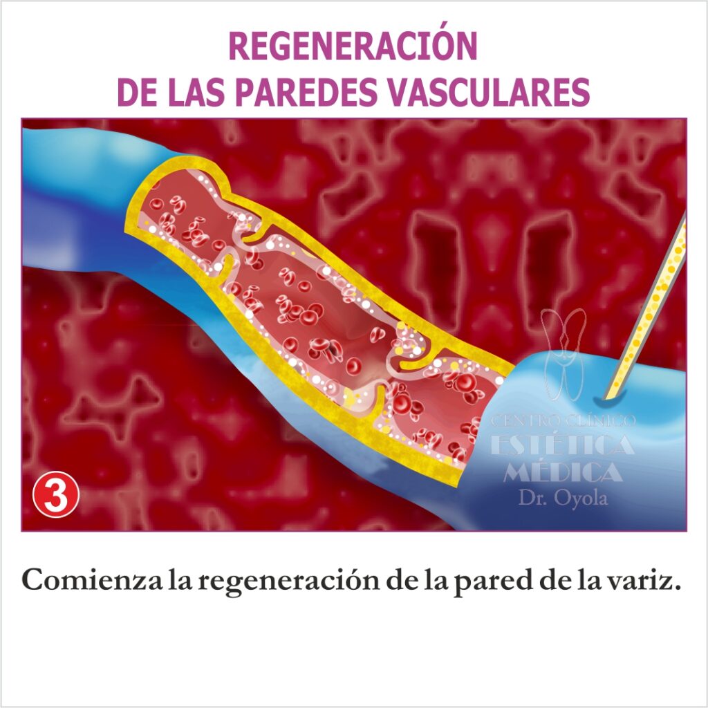 Regeneración paredes vasculares