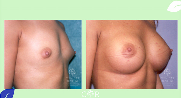 antes y después aumento de senos en chicas muy planas