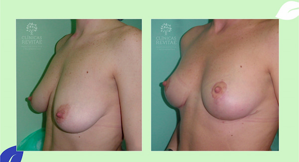 antes y después de operación elevación de pecho sin prótesis