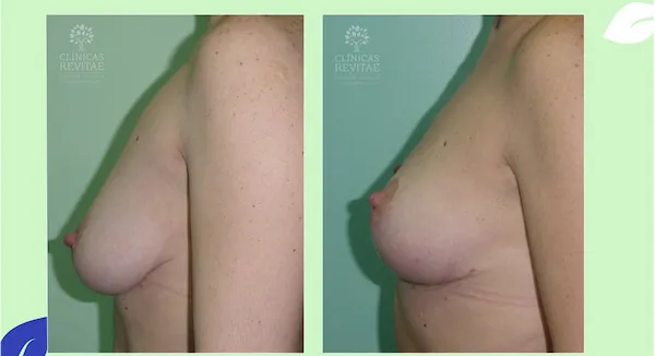 antes y después de operación elevación de senos sin prótesis