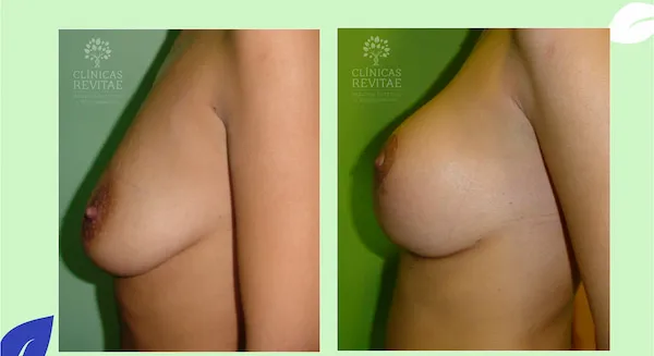 antes y después elevación de pecho en clínica de Cáceres