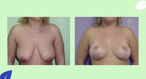 antes y después elevación de senos en clínica de Murcia