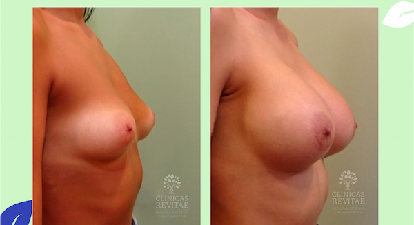 antes y después operación de senos 85 b tetas proyectadas