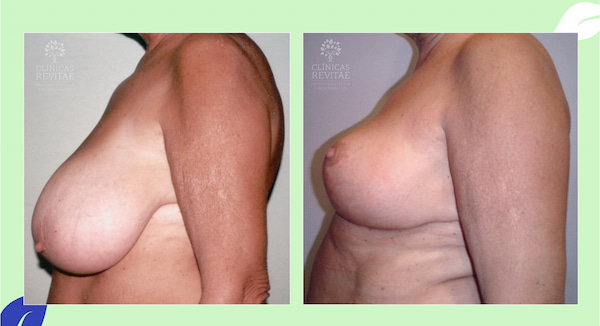 cirugía reducción de senos antes y después
