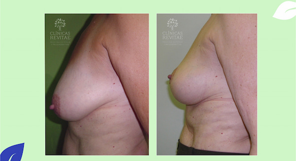 elevación de senos antes y después sin prótesis