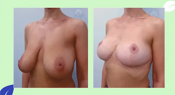 fotos elevación de senos antes y después operación