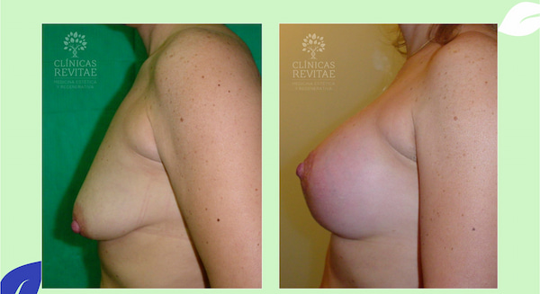 fotos elevación de senos antes y después