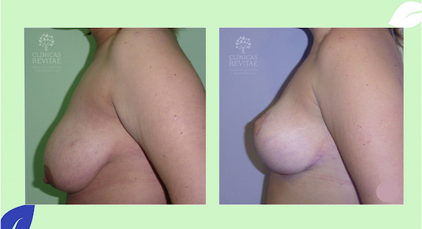 imágenes de mastopexia sin protesis antes y después