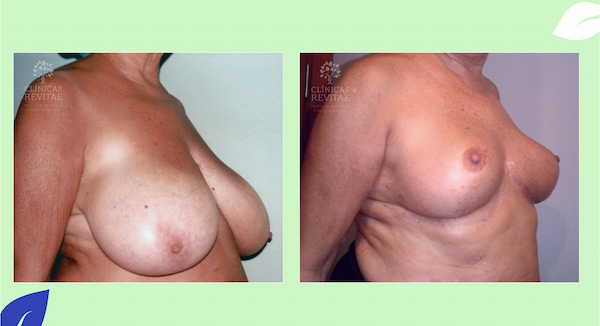 mamoplastia de reducción antes y después