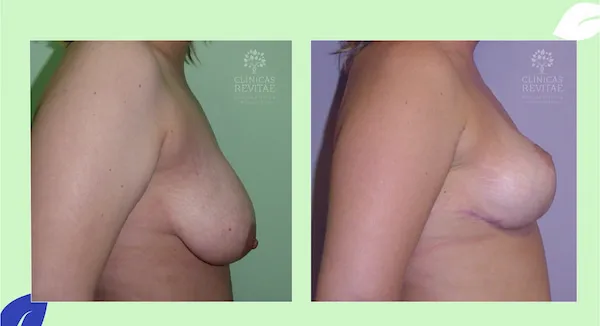 mastopexia antes y después sin implantes