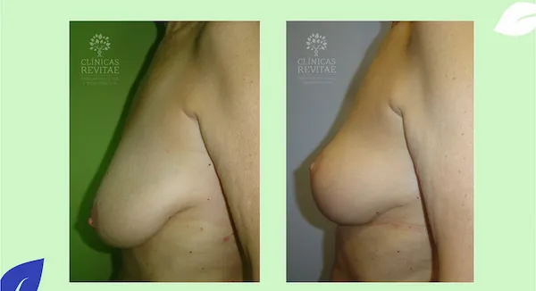 mastopexia sin protesis antes y después pechos grandes