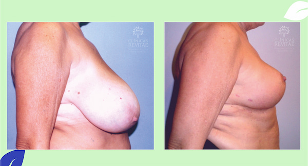 reduccion de mamas antes y después de cirugía