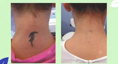 eliminacion tatuaje cuello