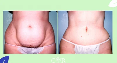Después Cirugía abdominoplastia antes y después del tratamiento