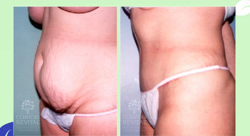 Antes de Abdominoplastia, abdominoplastia antes y después del tratamiento