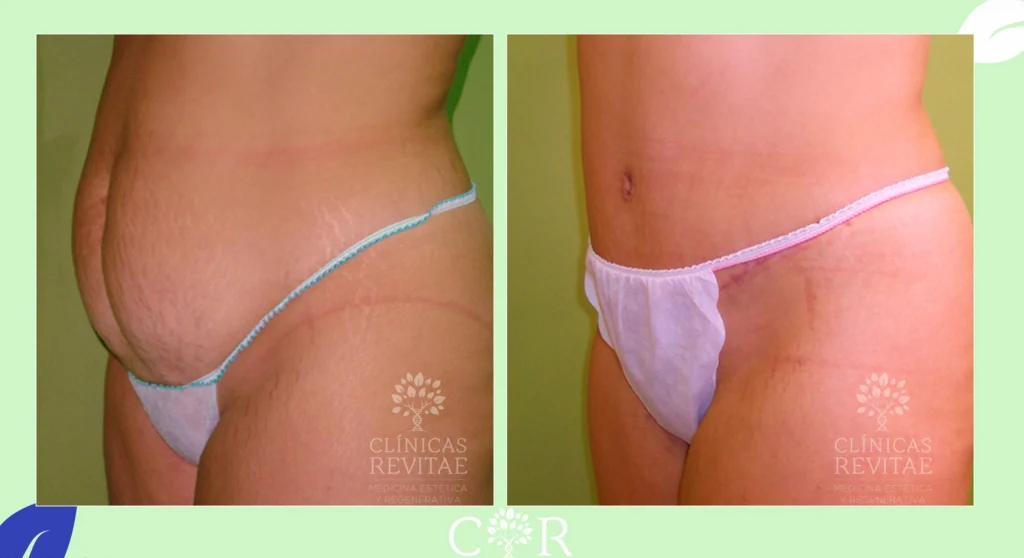 Antes de Cirugía abdominoplastia, abdominoplastia antes y después