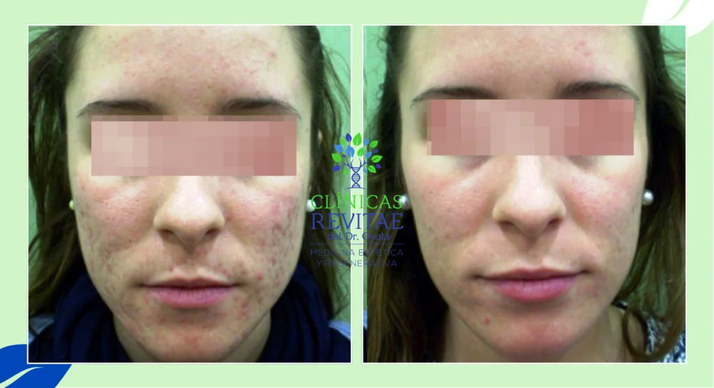 laser para cicatrices de acne antes y despues