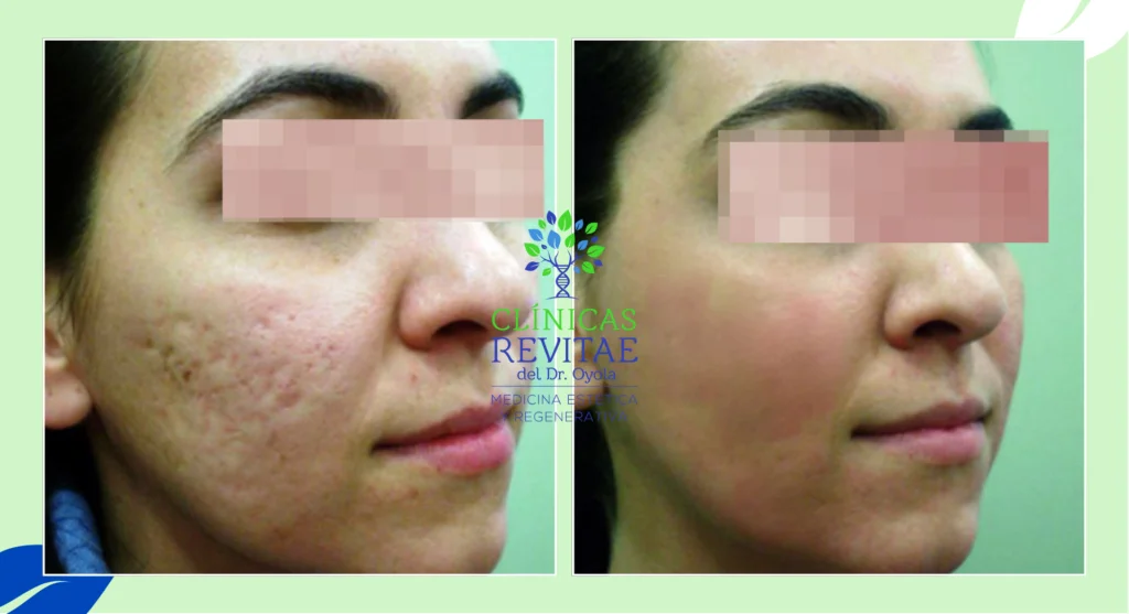 laser cicatrices acne