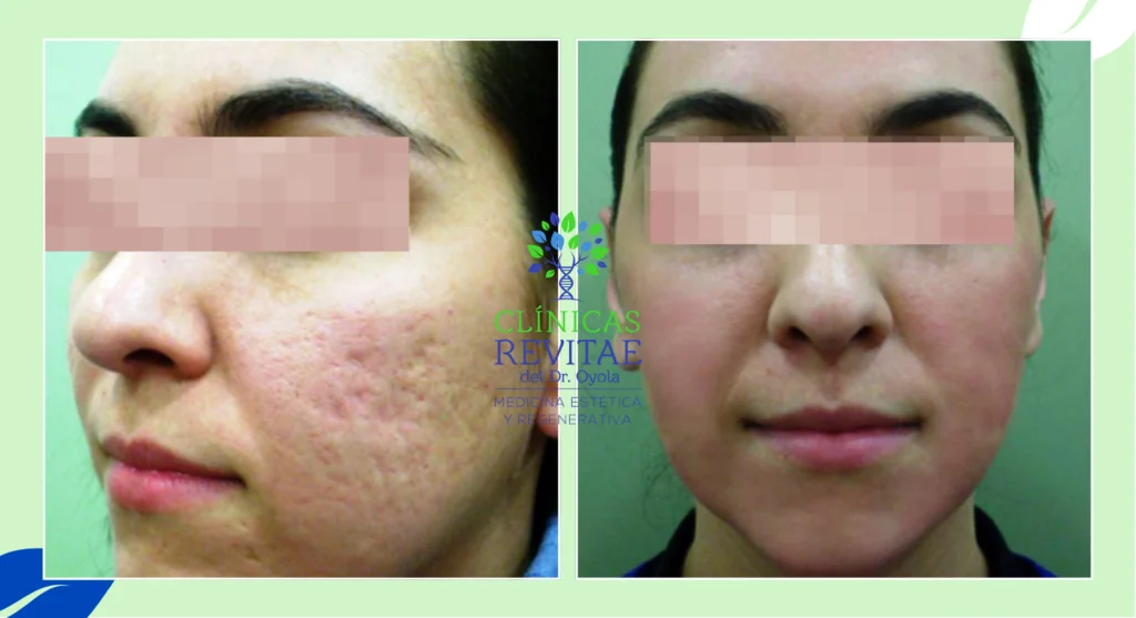 tratamiento laser acne
