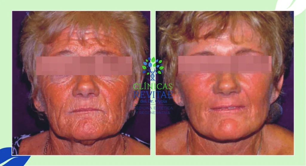 clinica para quitar arrugas dela cara, laser arrugas frente , laser para quitar arrugas