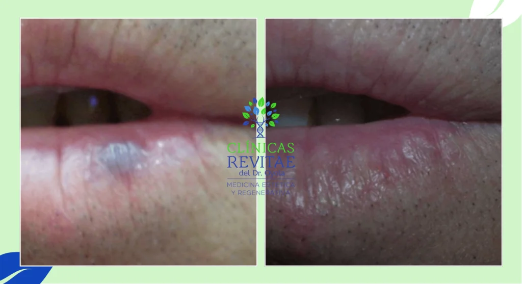 Antes y después de eliminar puntos Rubí o Microangiomas con láser, antes y después tratamiento para eliminar puntos Rubí del labio, eliminar mancha labio