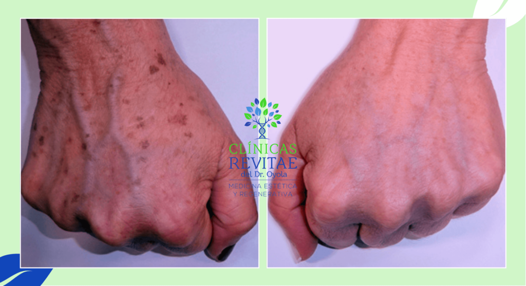 antes y después tratamiento manchas manos, rejuvenecimiento de manos antes y después, precio tratamiento de rejuvenecimiento de manos