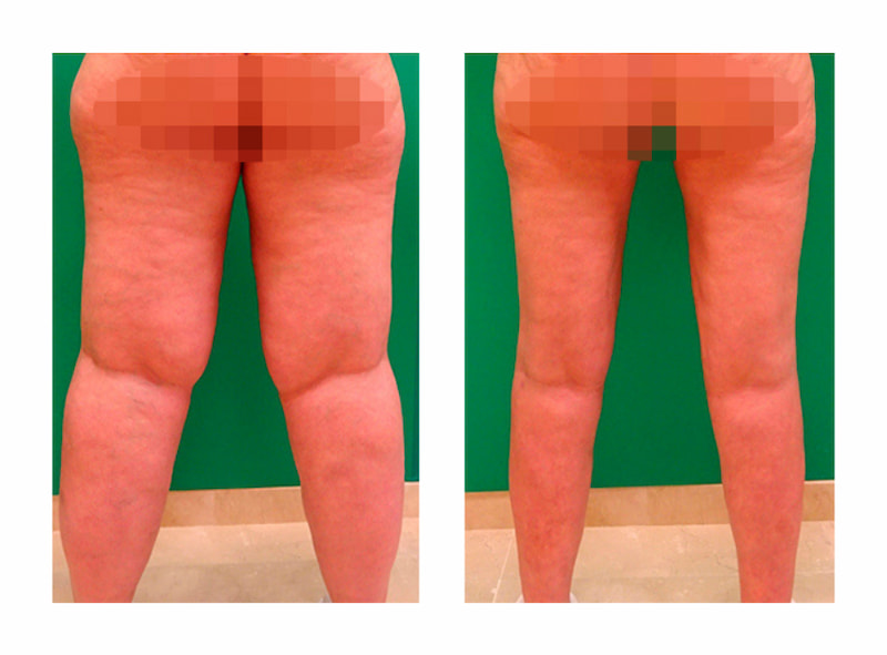 antes y después operación lipedema, lipedema piernas soluciones