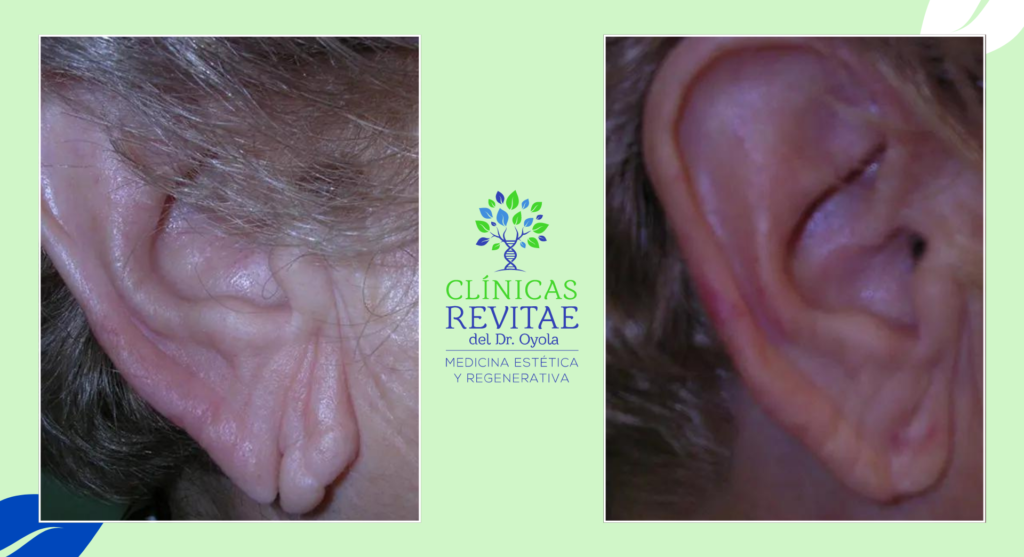 Antes y después de la reconstrucción del lóbulo rasgado: Mejora estética y restauración del lóbulo de la oreja