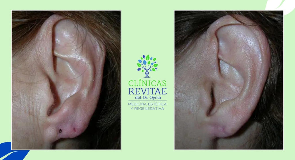 Resultado satisfactorio de la cirugía estética para lóbulo de oreja rasgado: Restauración y corrección visualmente agradable