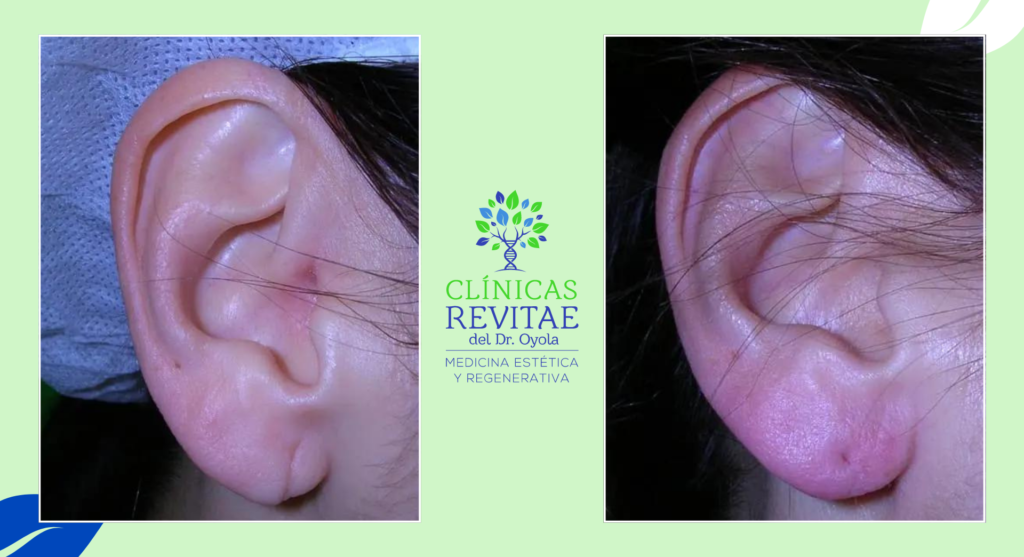 Tratamiento de lóbulo rasgado: Solución estética para agujeros dilatados y rotura total del lóbulo de la oreja