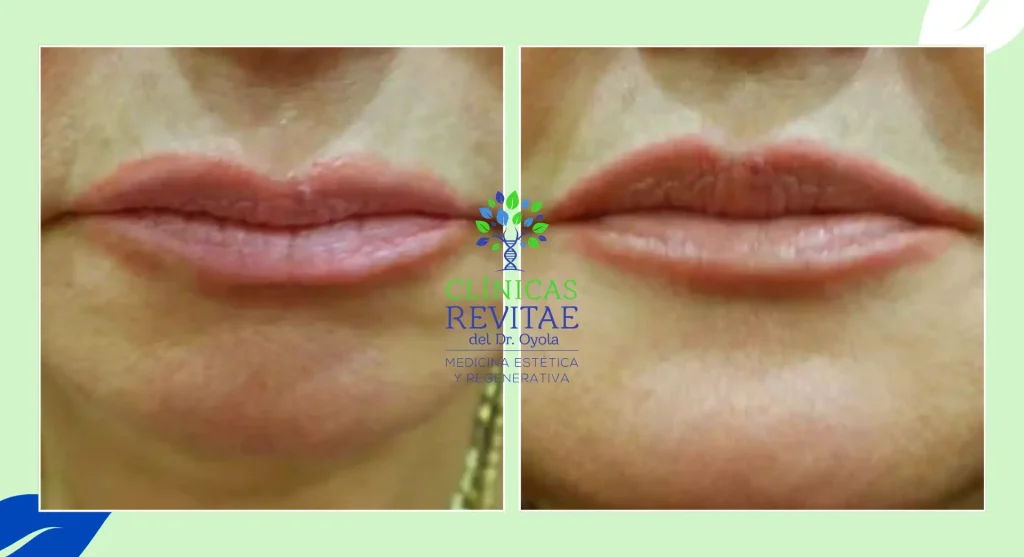 Tratamiento de rejuvenecimiento facial Perioral: volumen y definición en labios y surcos