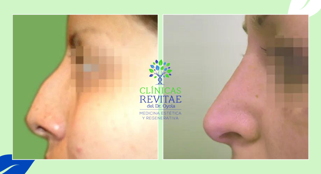 Transformación de nariz: imagen comparativa antes y después de la rinoplastia