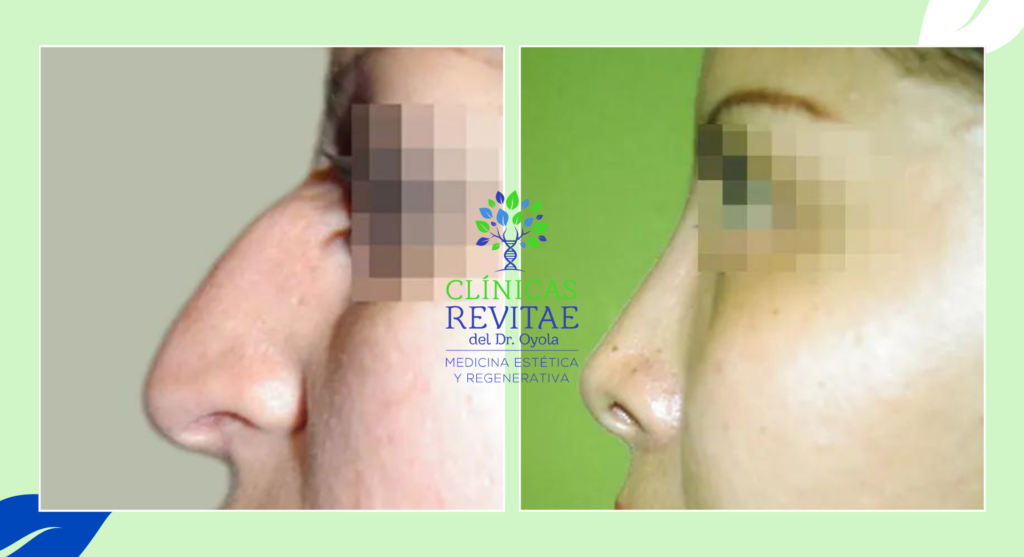 Antes y después de una rinoplastia: nariz original y nariz remodelada con éxito