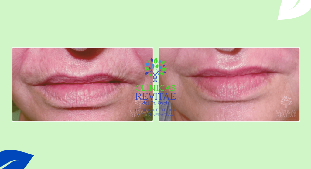 Resultados notables después del tratamiento láser para reducir el fotoenvejecimiento en la zona de los labios