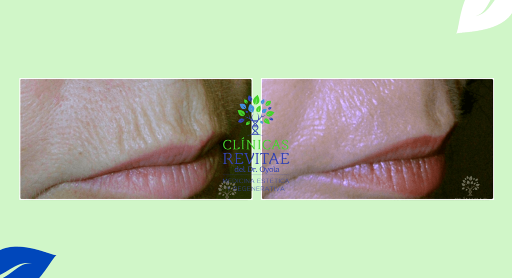 Mejora estética después del tratamiento láser para eliminar arrugas del labio superior
