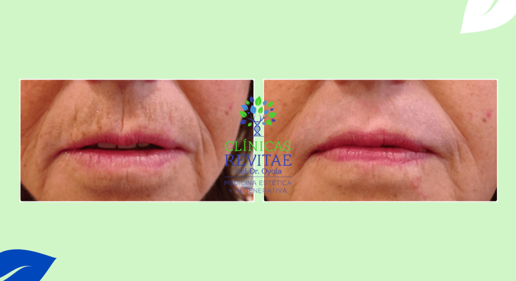 Imagen de antes y después del tratamiento láser para las arrugas peri bucales (código de barras)