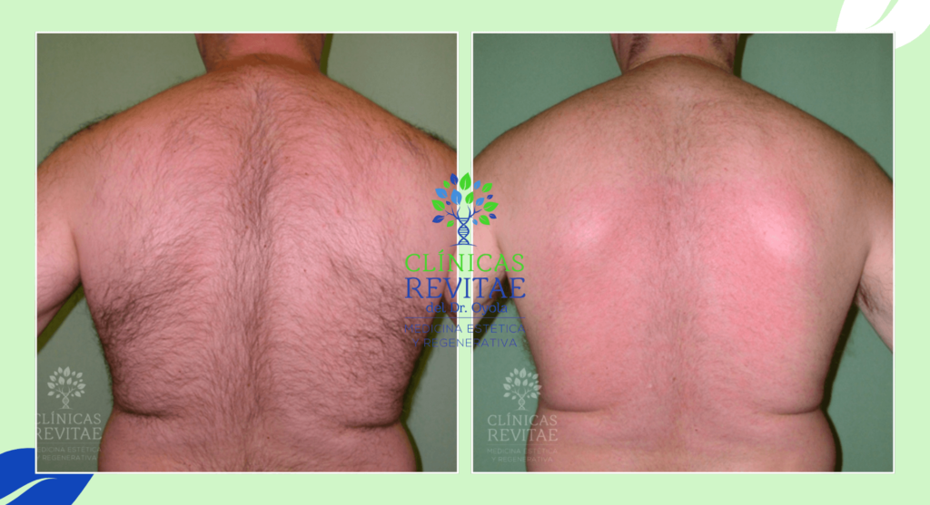 Antes y después de la depilación láser en hombres para eliminar el vello grueso y profundo