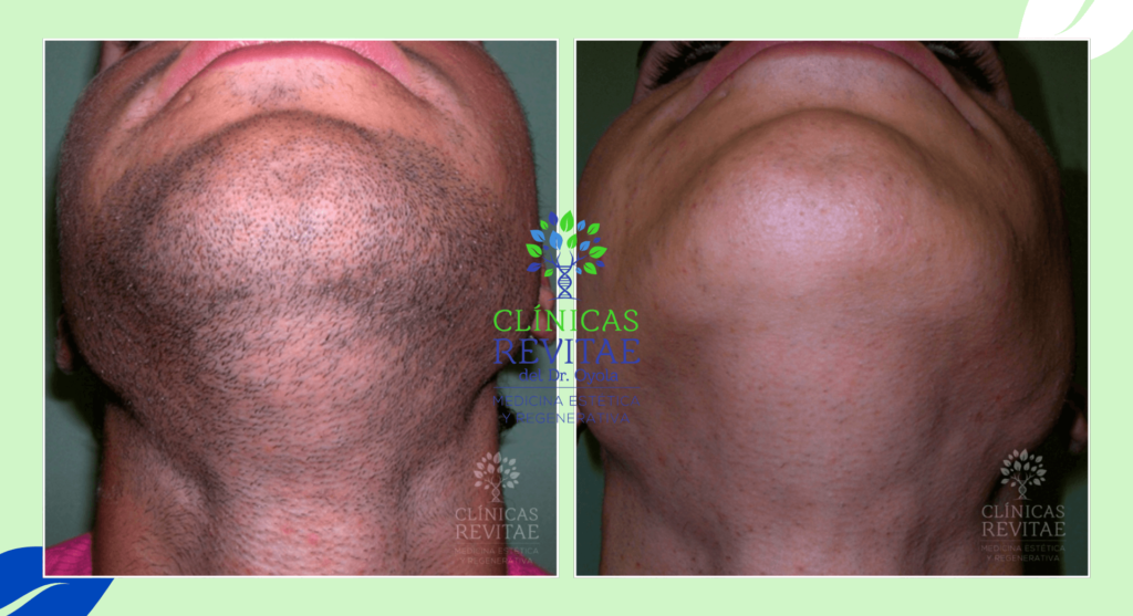 Resultados visibles del tratamiento de depilación láser para hombres en zonas "hormona-dependientes"