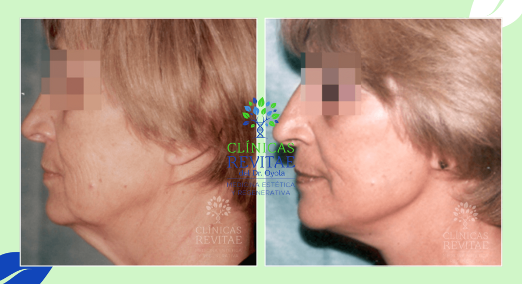 Transformación facial después de la operación de lifting facial para corregir el descolgamiento del tejido facial