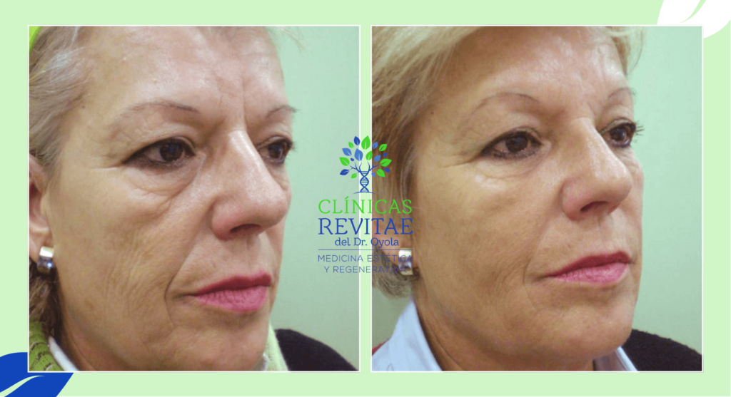 antes y después de neuromoduladores facial en mujer
